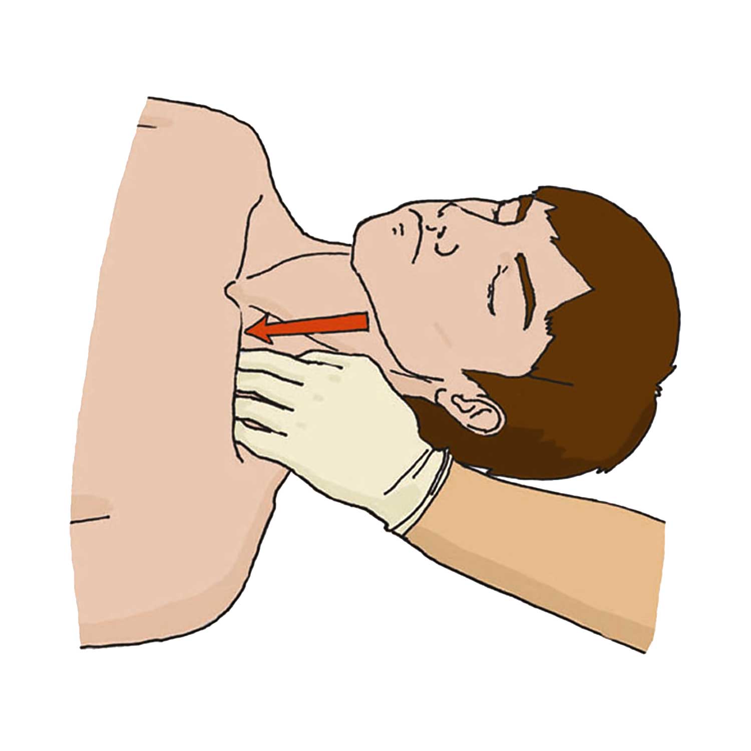 Вариант 1. Прижатие подключичной артерии выпрямленными пальцами